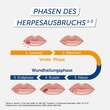 Pencivir bei Lippenherpes Creme - 4