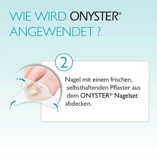 Onyster Nagelset - 5