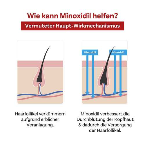 MINOXIDIL DoppelherzPharma 50 mg/ml L&ouml;sung f&uuml;r M&auml;nner - 6