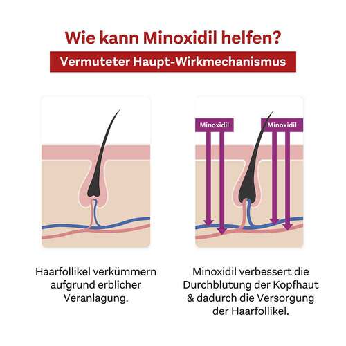 MINOXIDIL DoppelherzPharma 20 mg/ml L&ouml;sung f&uuml;r Frauen - 6