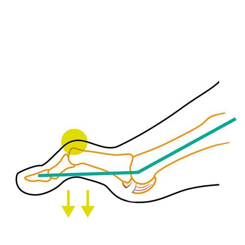 Compressana Tape Sox Hammerzehe 39 - 40 Gr&ouml;&szlig;e 4 schwarz - 3