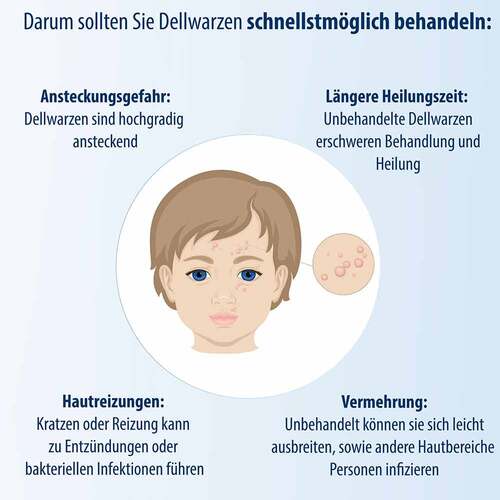 Evolsin Dellwarzen Mittel L&ouml;sung - 4